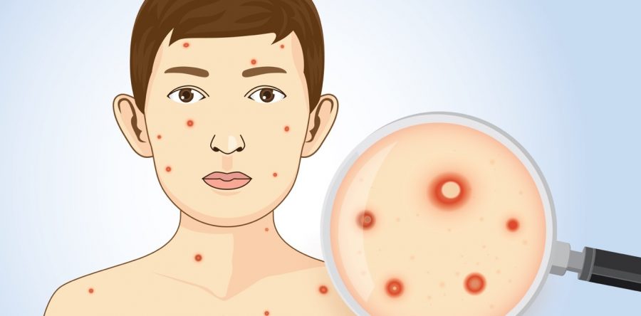 En siete años, registra Oaxaca la incidencia más baja de casos de varicela