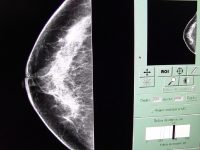 Promueve SSO la autoexploración como medida fundamental contra el cáncer de mama