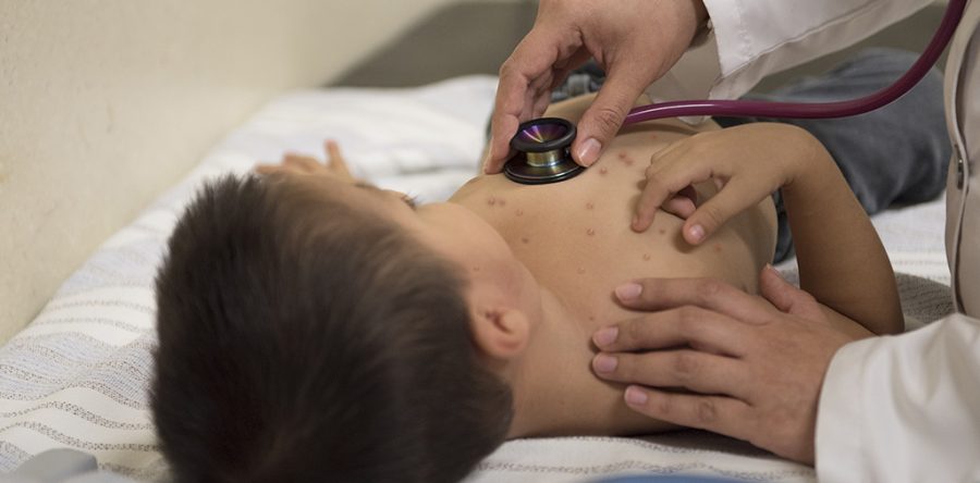 Exhorta SSO a prevenir y atender oportunamente la varicela