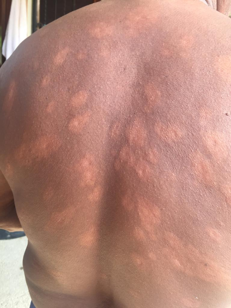 Oaxaca avanza en la eliminación de la Lepra, con jornadas dermatológicas