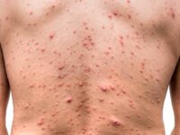 Confirman los Servicios de Salud de Oaxaca el primer caso de viruela del mono