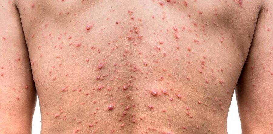 Confirman los Servicios de Salud de Oaxaca el primer caso de viruela del mono