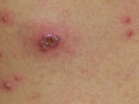 México suma 386 casos de viruela del mono; 24 estados, con contagios; Oaxaca se mantiene con 2