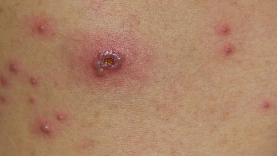 México suma 386 casos de viruela del mono; 24 estados, con contagios; Oaxaca se mantiene con 2