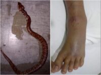 Una niña en Río Grande sufre mordedura de serpiente venenosa
