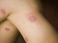 La rabia no es contagiosa de una persona a otra: Acevedo Noyola