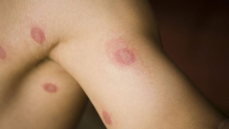 La rabia no es contagiosa de una persona a otra: Acevedo Noyola