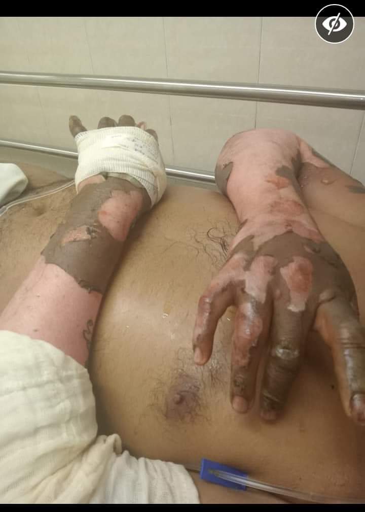 Piden atención especializada para la familia que resultó con quemaduras en Matías Romero